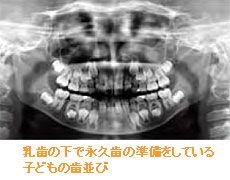 乳歯の下で永久歯の準備をしている子どもの歯並び