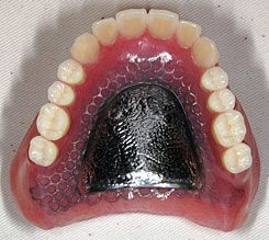 チタン合金　金属床総義歯