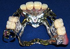 コバルトクロム合金　部分床義歯