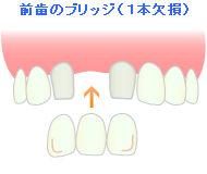 前歯のブリッジ（1本欠損）