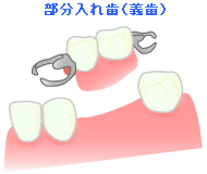 部分入れ歯（義歯）