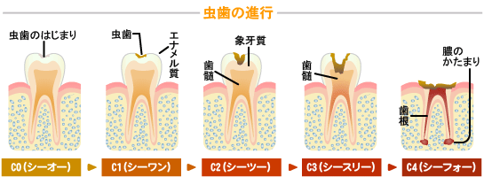 虫歯の進行