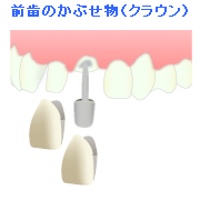 前歯のかぶせ物（クラウン）