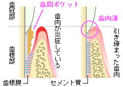 歯肉溝と歯周ポケット