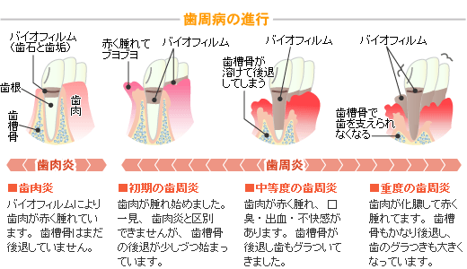 歯周病の進行