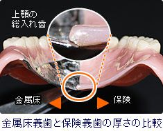 金属床義歯と保険義歯の厚さの比較