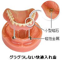 グラグラしない快適入れ歯