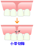 小帯切除