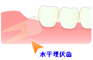 水平埋伏歯