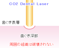 CO2 Dental Laser